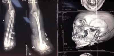 Tự chế ph&aacute;o, thanh ni&ecirc;n Hải Ph&ograve;ng cụt cả 2 tay