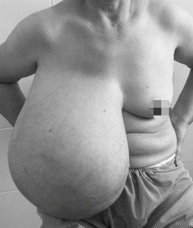 Người phụ nữ mang &ldquo;n&uacute;i đ&ocirc;i&rdquo; ch&ecirc;nh nhau gần 9 kg