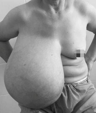 Người phụ nữ mang &ldquo;n&uacute;i đ&ocirc;i&rdquo; ch&ecirc;nh nhau gần 9 kg