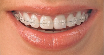 Chị em nếu đang có ý định niềng răng, hãy đọc ngay thông tin này trước rồi hẵng quyết định
