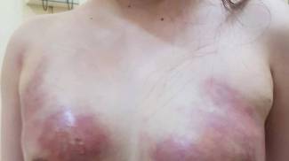 C&ocirc; g&aacute;i trẻ bị hoại tử ngực v&igrave; bơm mỡ nh&acirc;n tạo ở Spa