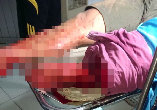 Khoe c&oacute; tổ ong lớn, bị ch&eacute;m gần l&igrave;a ch&acirc;n v&igrave; cho rằng "nổ"