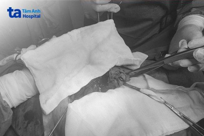 Bỏ qu&ecirc;n băng gạc y tế trong bụng suốt gần 10 năm