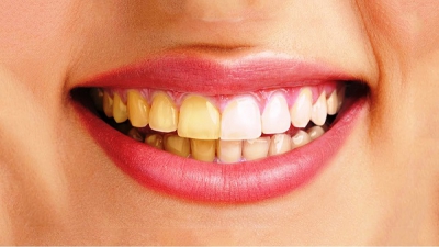 Xử lý răng ố vàng nhờ 4 cách đơn giản