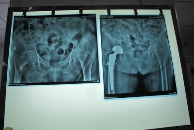 Cụ b&agrave; 111 tuổi được thay khớp h&aacute;ng th&agrave;nh c&ocirc;ng