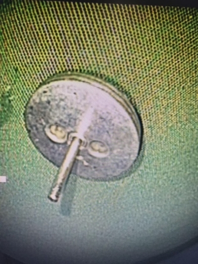 Cấp cứu b&eacute; trai 4 tuổi nuốt dị vật bằng kim loại