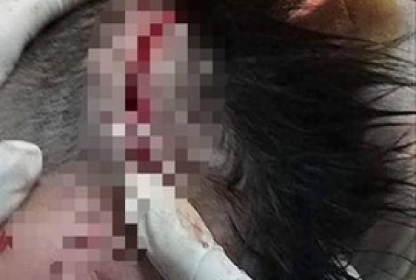 B&eacute; trai 4 tuổi bị ch&oacute; becgie nh&agrave; lao v&agrave;o cắn x&eacute;