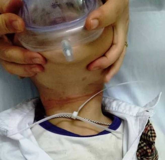 C&ocirc; gi&aacute;o đưa học sinh cấp cứu v&igrave; d&acirc;y nhựa th&iacute;t cổ