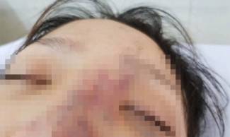 Một nữ sinh c&oacute; nguy cơ m&ugrave; mắt v&igrave; ti&ecirc;m filler