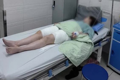 Hút mỡ đùi, người phụ nữ bị hoại tử nghiêm trọng
