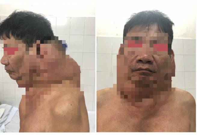 "Người gấu" được phẫu thuật th&agrave;nh c&ocirc;ng khối u khổng lồ