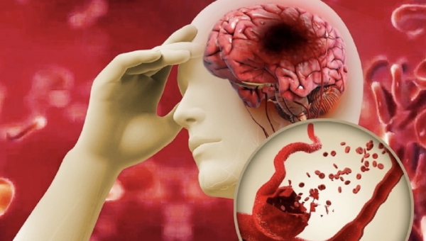 Nhiều người trẻ bị đột quỵ, có cần tầm soát nguy cơ?