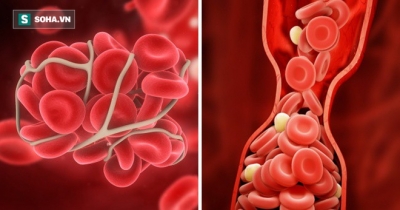 10 c&aacute;ch để ngăn ngừa cục m&aacute;u đ&ocirc;ng c&oacute; thể cứu sống bạn: Đừng bỏ lỡ th&ocirc;ng tin qu&yacute; gi&aacute;